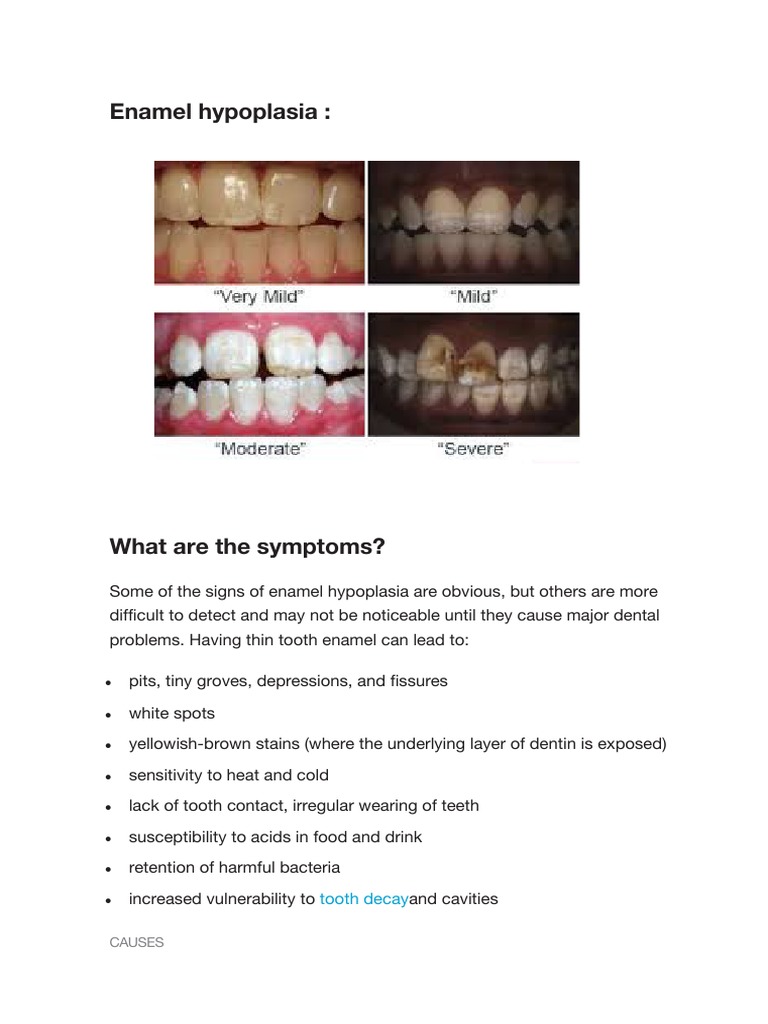 Enamel Hypoplasia:: Tooth Decay | PDF | Tooth Enamel | Human Tooth