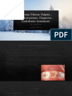 Chronic Fibrous Pulpitis Clinical Picture, Diagnosis, Endodontic Treatement