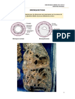 Bronquiectasias: alteraciones en la pared y microscopía