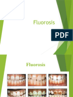 Fluorosis