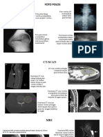 Spondilitis TB Radiologi