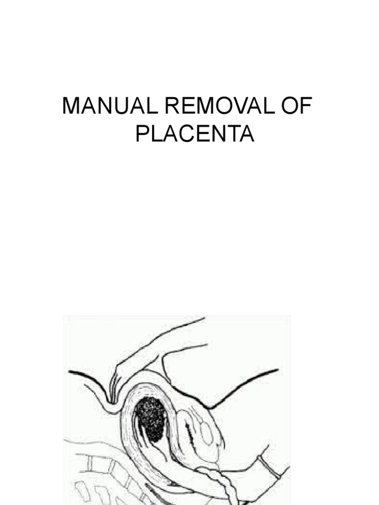 Manual Removal of Placenta PDF Uterus Placenta