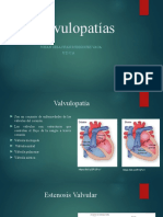 Valvulopatías 