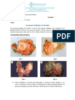 Carcinoma Papilar de Tiroides.docx