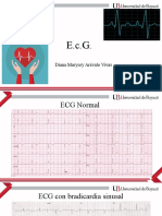 ECG normal y bradicardia sinusal
