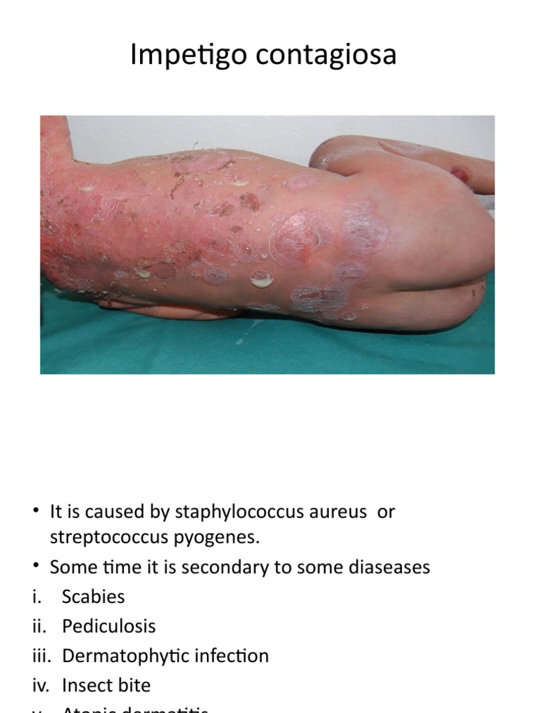 Impetigo Contagiosa PDF Cutaneous Conditions Immunology