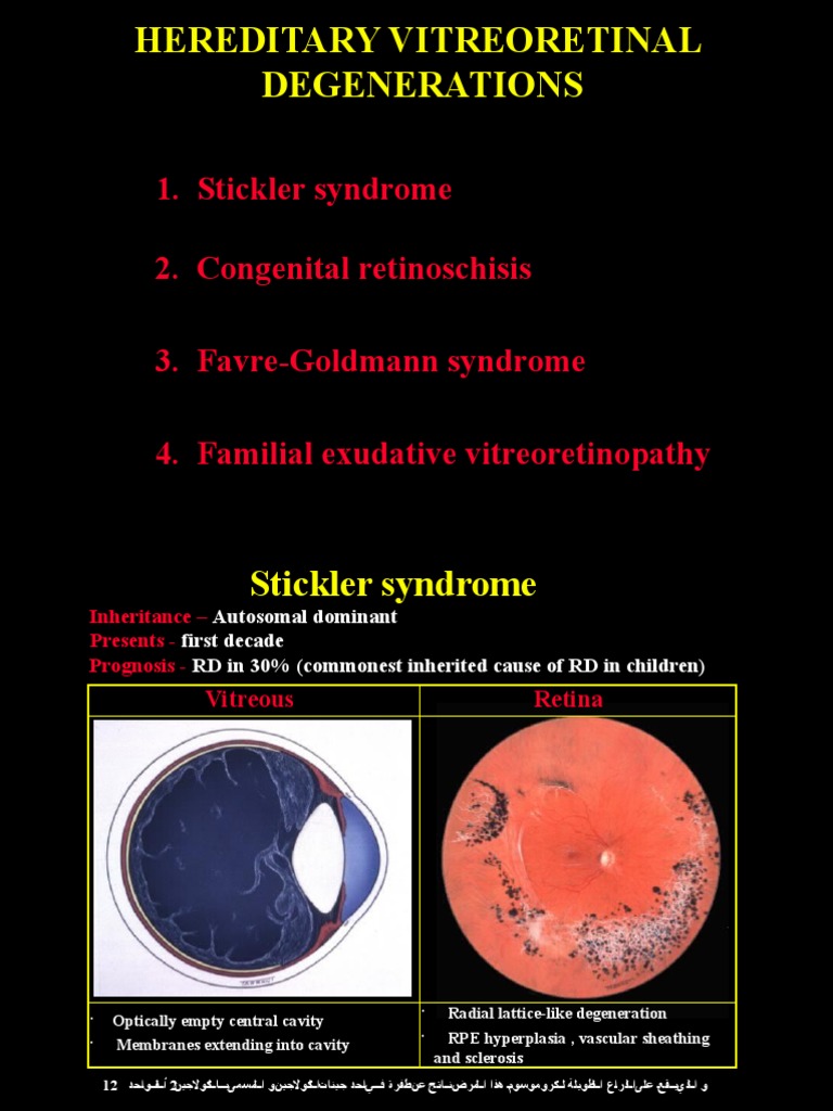 stickler syndrome retina