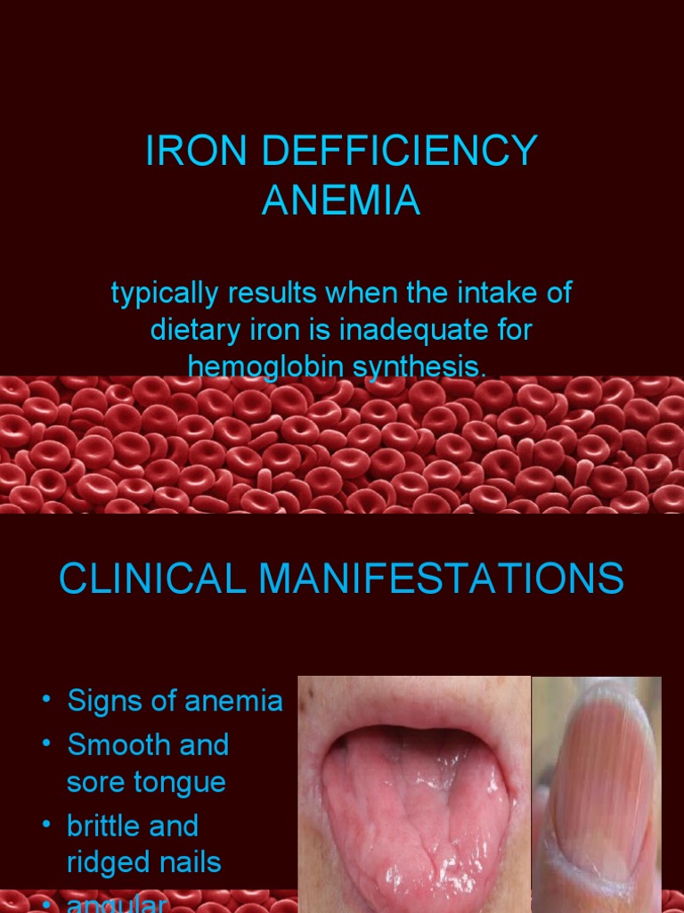 Iron Defficiency Anemia Typically Results When The Intake of Dietary Iron Is Inadequate For