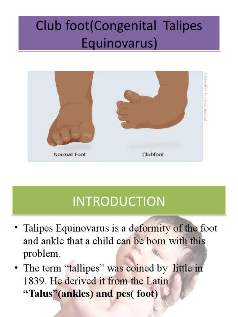 Club Foot (Congenital Talipes Equinovarus) Club Foot (Congenital