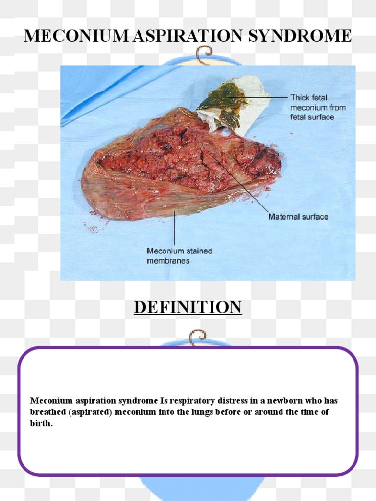 Meconium Aspiration Syndrome PDF Medical Specialties Diseases And Disorders
