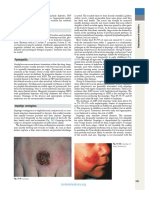 (ANDREWS) Impetigo, Ecthyma PDF