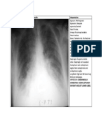 Chest X-Ray Cardiomegaly Pleural Effusion