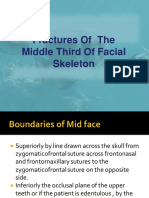 Fractures Midface