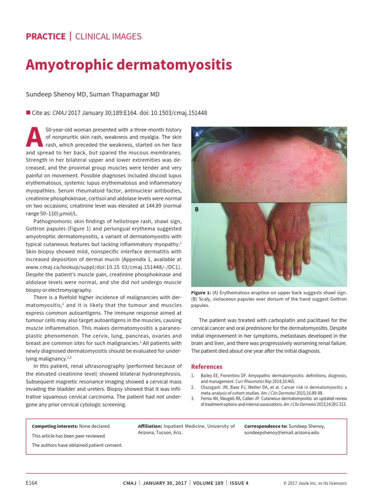 Amyotrophic Dermatomyositis PDF | PDF | Cervical Cancer | Immunology