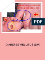 Diabetes Mellitus