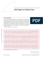An Ominous ECG Sign in Critical Care: Circulation