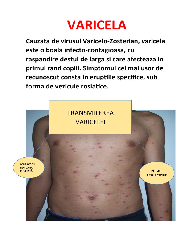 VARICELA | PDF