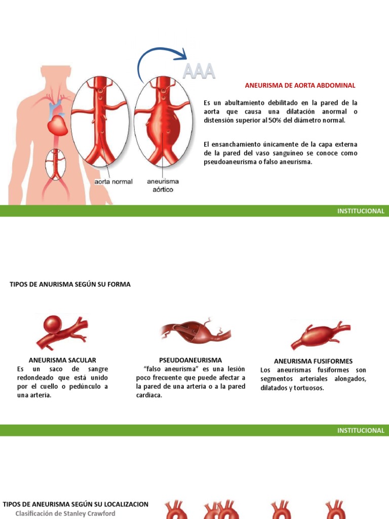 Aneurisma de Aorta Abdominal | PDF | Abdomen | Aorta