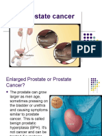 Prostate Cancer Symptoms, Screening, Stages and Treatment Options