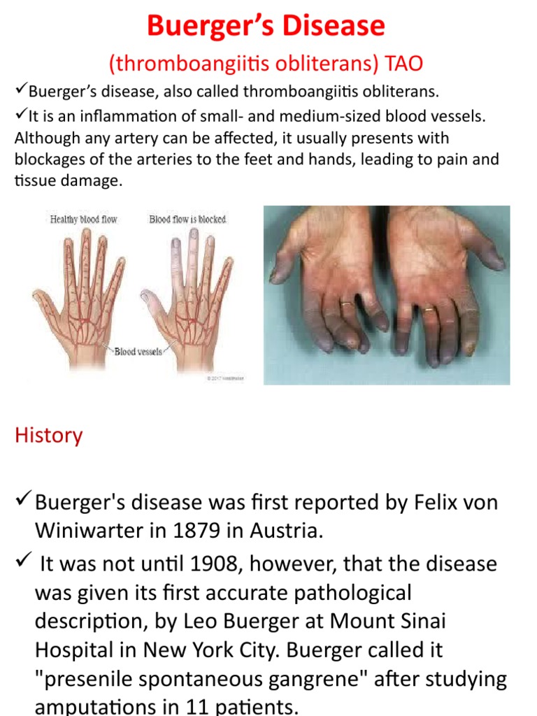 Burgers Disease PDF Angiology Health Sciences