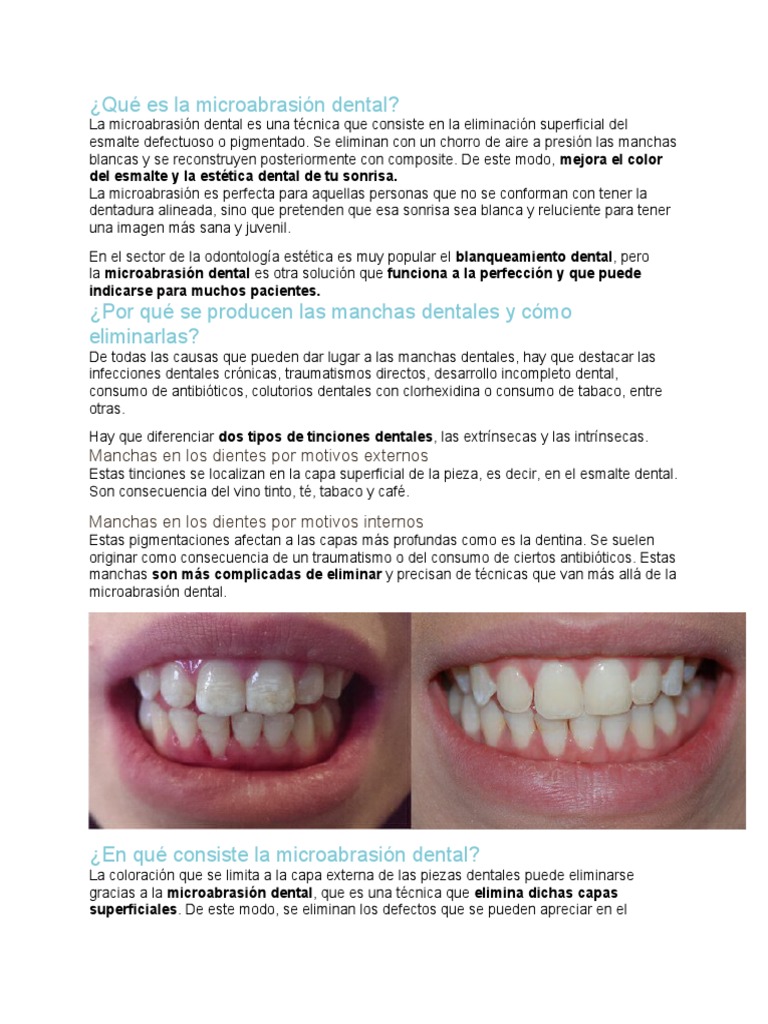 Qué es la microabrasión dental PDF Química Naturaleza