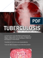 Tuberculosis Secundaria y Miliar