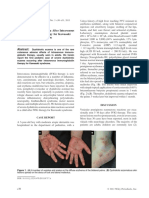 Severe Dyshidrotic Eczema After Intravenous Immunoglobulin Therapy For Kawasaki Syndrome