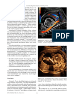 Útero Del Fetus in Fetu Inicialmente Es Similar Al de Su Gemelo