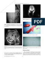 Fetus in Fetu. Diagnóstico Prenatal y Tratamiento Post-Natal