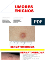 DERMOFIBROMA