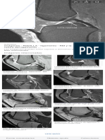 resonancia normal de ligamento cruzado anterior - Búsqueda de Google