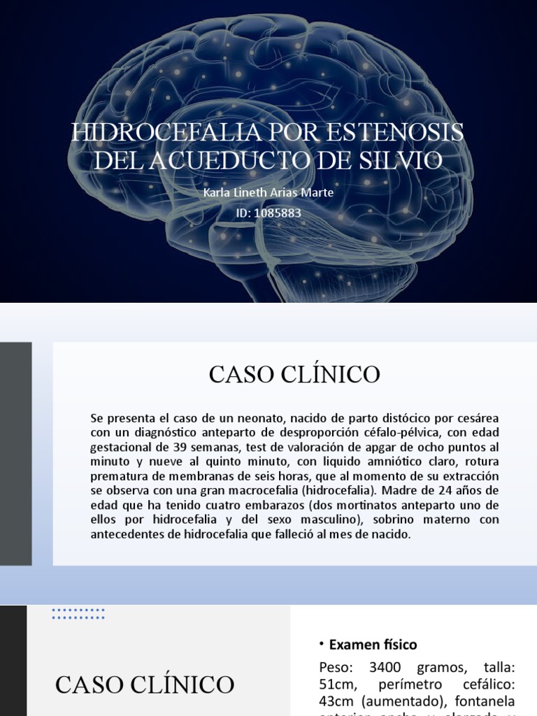 hidrocefalia-por-estenosis-del-acueducto-de-silvio-pdf-enfermedades