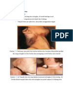 2.1 Strangulation 2.1.1 Penemuan Post Mortem