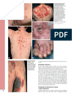 Fig. 29.6 Pemphigus Vulgaris - Cutaneous Involvement. A Flaccid Blisters and An Erosion B, C Multiple Erosions and