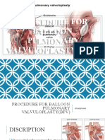Procedure For Ballon Pulmonary Valvuloplasty (BPV)