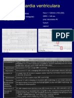 Aritmii Ventriculare PDF