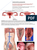 endometrita.docx