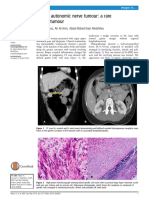 Abbas, Al-Arini, Meshikhes - 2014 - Gastric autonomic nerve tumour A rare gastric tumour.pdf