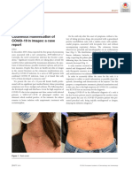 Cutaneous Manifestation of COVID-19 in Images: A Case: Jeadv