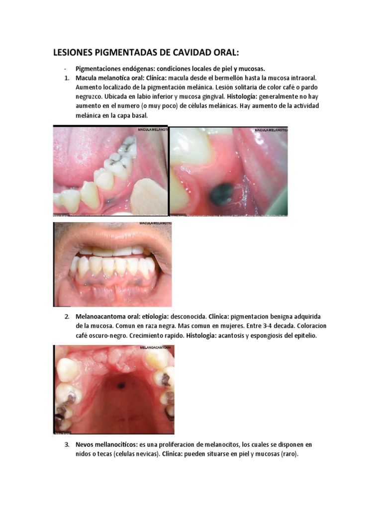 Lesiones Pigmentadas en Cavidad Oral | PDF | Neoplasias