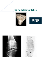 Fracturas de La Meseta Tibial Pinto