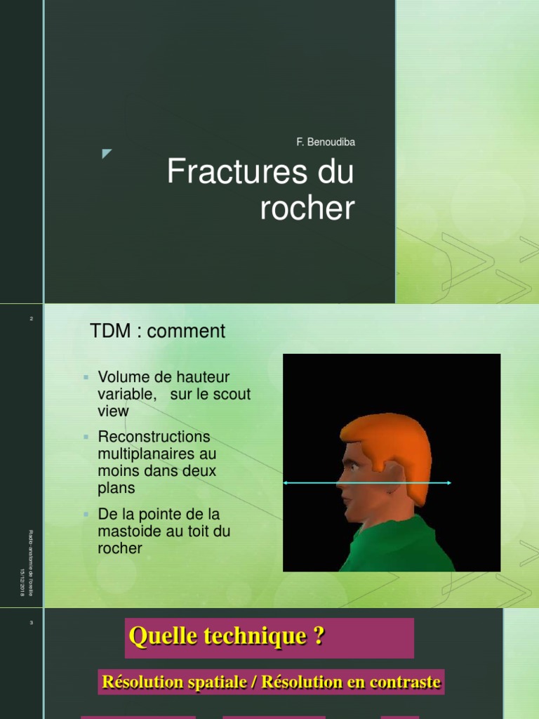 Fractures du rocher : diagnostic et évaluation | PDF | Traumatisme ...
