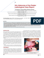 Pleomorphic Adenoma of The Palate: Clinicoradiological Case Report
