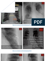 Thorax X-Ray of COVID-19