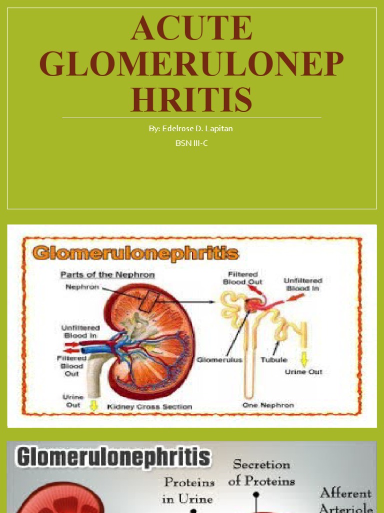 Acute Glomerulonephritis | PDF | Edema | Hypertension