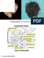 Presentation Cholelithiasis