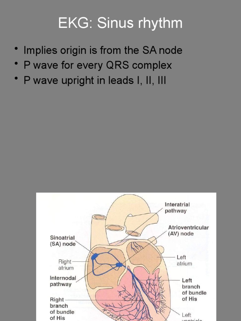EKG Sinus Rhythm and Arrhythmias Guide | PDF | Electrocardiography ...