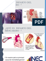 Infarto miocardio causas síntomas tratamiento