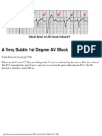 A Very Subtle 1st Degree AV Block