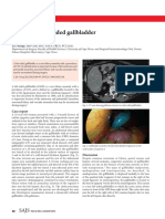 Beware Left-Sided Gallbladder (LSGB